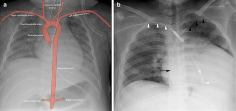 Normal arterial anatomy and arterial catheter placement. Aorta and main ...