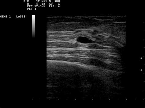 A A Simple Breast Cyst 75 B Breast Ultrasound Showing A Cancer | Images ...