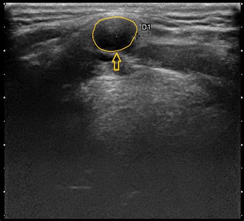 Thyroid Goiter Ultrasound