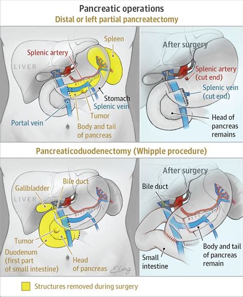 Pin on Pancreas