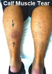 Calf Muscle Pain: Causes, Diagnosis, Symptoms & Treatment