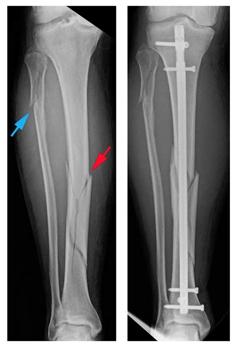 ️ Broken tibia and fibula healing time. What Is the Healing Time for a ...