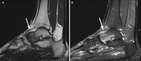 Bone Marrow Edema Syndrome