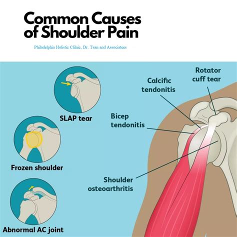 Treatment for Frozen Shoulder - Philadelphia Holistic Clinic - Dr Tsan ...