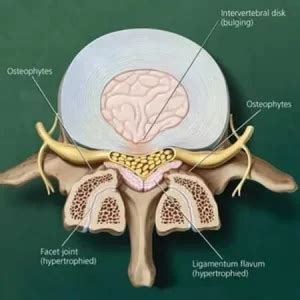 Ligamentum Flavum - Anatomy, Structure, Function