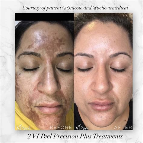 Are you ready for a VI Peel? | Cynthia Golomb, MD | Dermatology Boutique