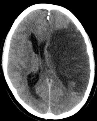 Stroke Medicine for Stroke Physicians and Neurologists