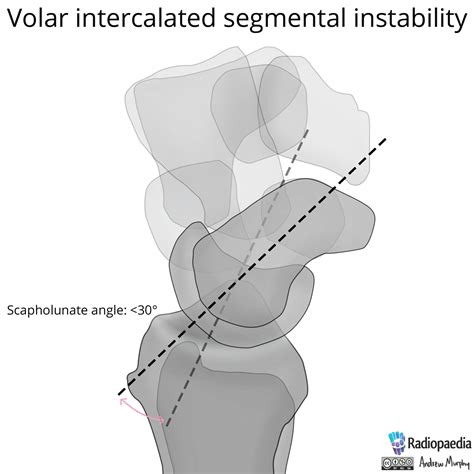 File:Normal wrist alignment, dorsal and volar intercalated segmental ...