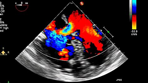 Atrial Septal Defect Primum Echocardiography - YouTube