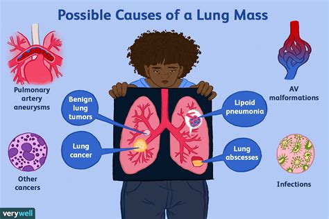 Causes possibles d'une masse pulmonaire