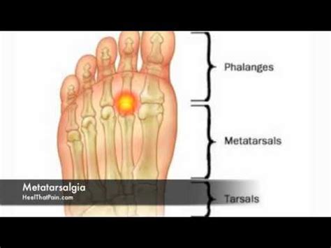 20 Best Metatarsalgia Shoes Reviewed - Relieve Ball of Foot Pain 2019