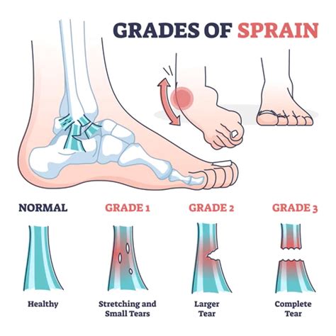 Ankle Sprain or Ligament Injury - Bunbury Foot & Ankle Surgeon