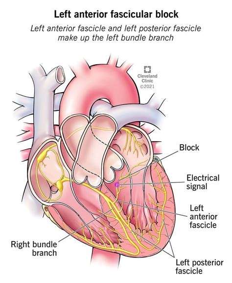 Left anterior fascicular block causes and treatment – Artofit