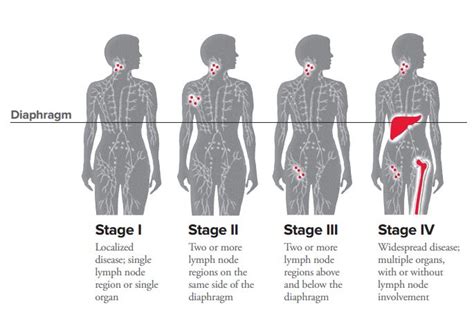 https://www.lls.org/lymphoma/hodgkin-lymphoma/diagnosis/hodgkin ...