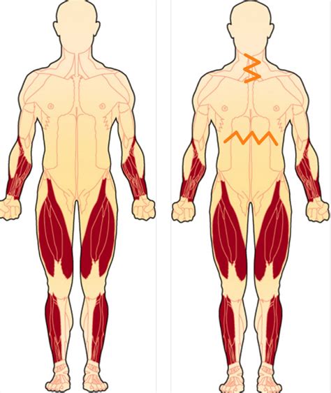 Inclusion body myositis – Artofit