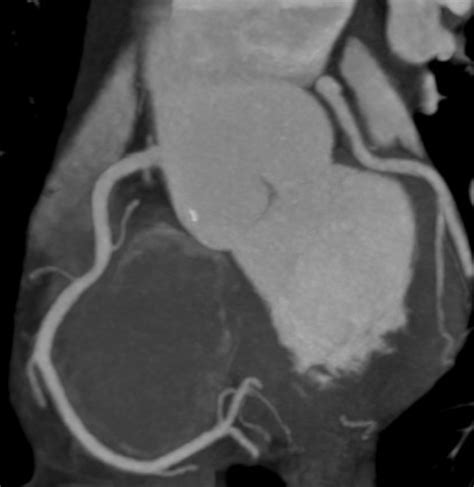 Cardiac CT - Coronary CT Angiography | Learn the Heart