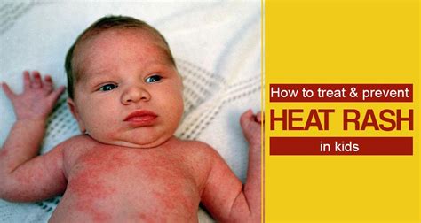 Home Remedies for Heat Rashes in Kids | Prevention and Treatment