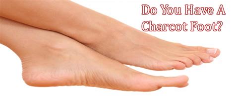 Charcot Foot Is A Serious Foot Disorder - Chiropractor San Diego Dr ...