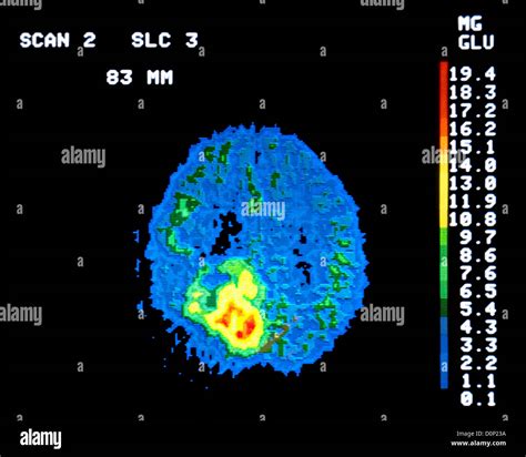 A PET scan (positron emission tomography) 62 year old man brain tumor ...