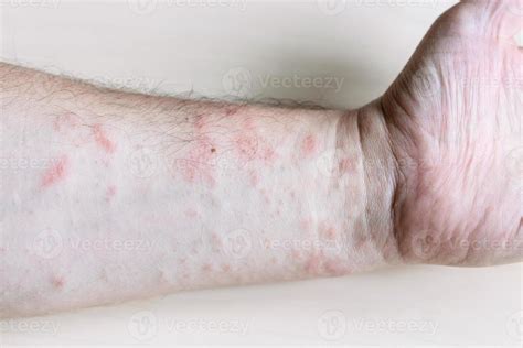 ink rash on inner side of forearm close up 11186198 Stock Photo at Vecteezy