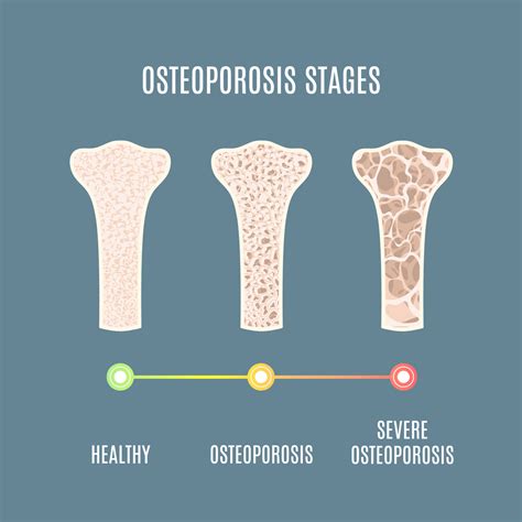 Progression and Possible Complications of Osteoporosis | PainScale