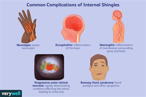 What Is Internal Shingles?