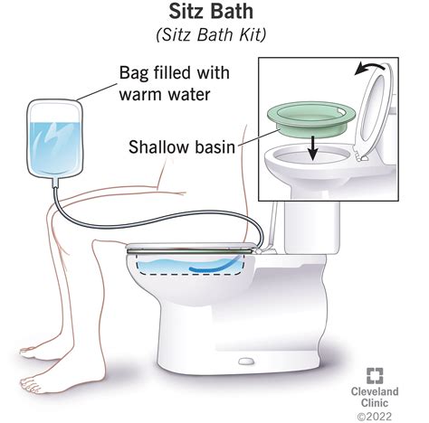 Sitz Bath: Definition Benefits, 58% OFF | www.pinnaxis.com