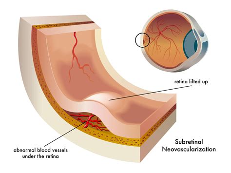 Wet Macular Degeneration: Symptoms, Treatment, and Research Updates