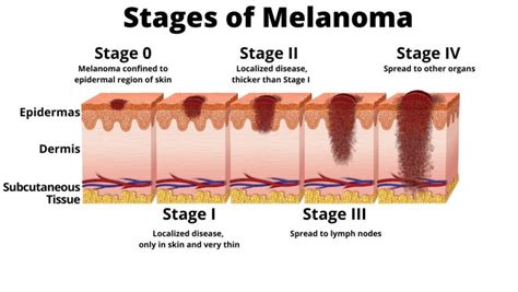 Melanoma In-Situ- Should You Worry? - PeopleBeatingCancer