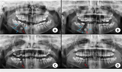 Panoramic radiographs A. Radiograph view demonstrating the dentigerous ...