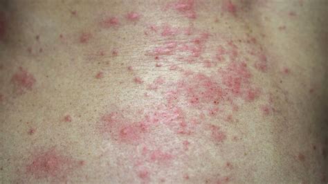 Bacterial Fungal Skin Rash – Themelower