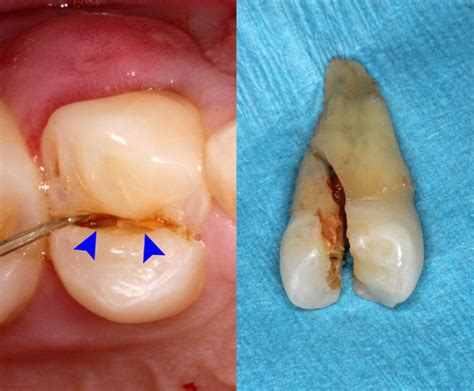 Chronic Trigeminal Neuropathy: Differential Testing for Tooth Fractures