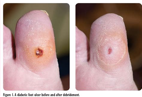 Figure 1 from Sharp debridement of diabetic foot ulcers and the ...