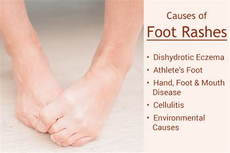 Foot Rashes: Causes, Treatment & Home Remedies