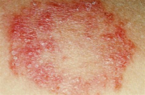 Skin Fungal Rash