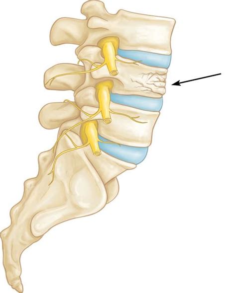 Osteoporosis and Spinal Fractures - Orthopedic & Sports Medicine