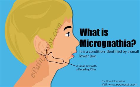 Micrognathia | Personalized medicine, Childrens health