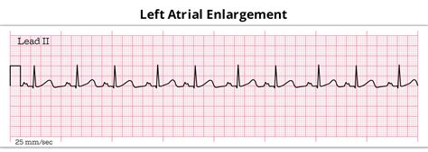 What You Must Know About Left Atrial enlargement?