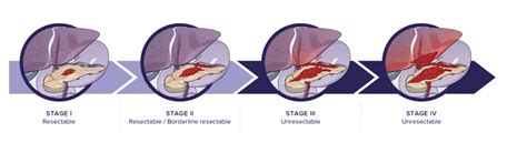 How is the extent of pancreatic cancer assessed (staging ...