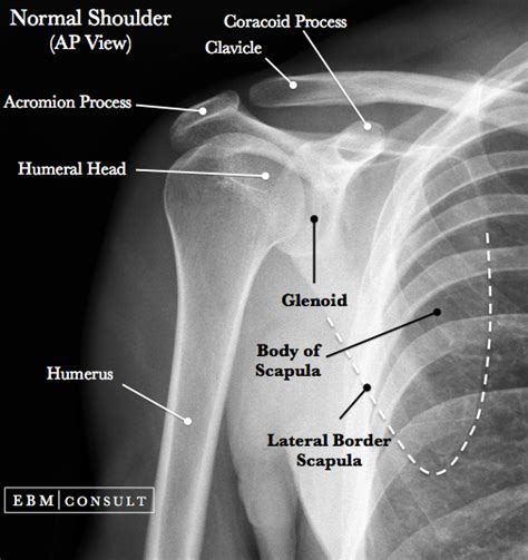 Posterior Shoulder Dislocation - General Review