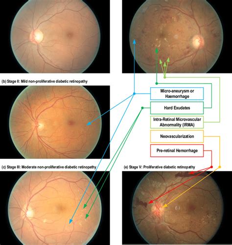 Fundoscopic images of different stages of diabetic retinopathy. (a ...