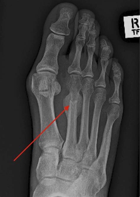 Surgical Realignment of a Dorsiflexed Metatarsal Fracture | Cureus