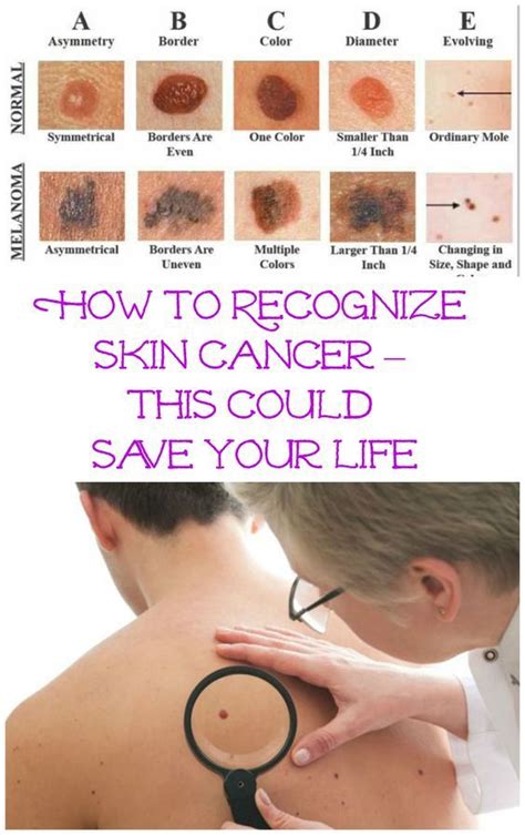 How To Recognize Skin Cancer This Could Save Your Life | Health tips ...