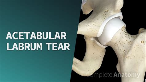 Acetabular Labrum Tear | Pathologies - YouTube