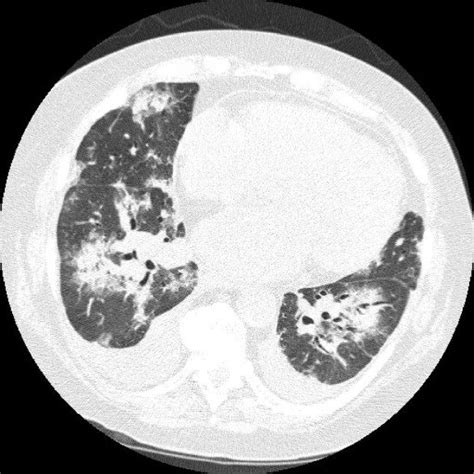 Histology of BOOP. Alveolar space is occupied by organizing pneumonia ...