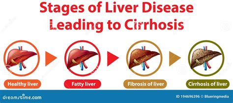 Stages Of Liver Disease Leading To Cirrhosis Stock Vector | Free ...