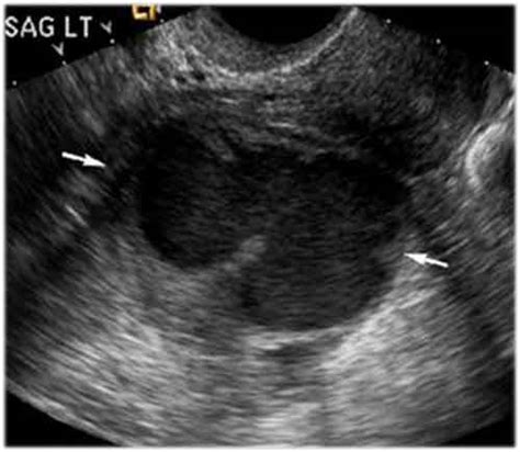 Tubo-ovarian Abscess