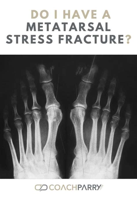 Fracture symptoms – Artofit