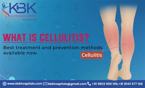 cellulitis causes Archives - kbkhopitals