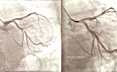 Angiogram